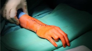 Ruka pacientky po voperování náhrady zápěstní kůstky. Foto: Krajská zdravotní